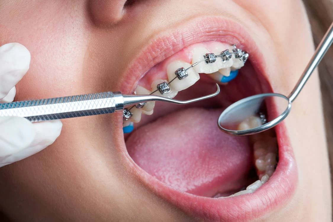 دليلك لدراسة تقويم الأسنان في مصر للوافدين